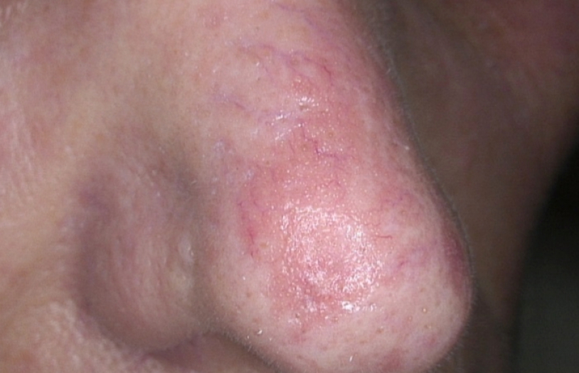 Rosacea kezelés lézerrel